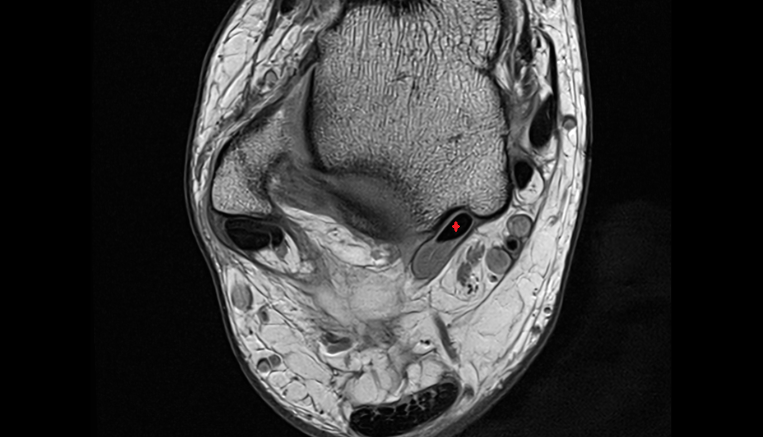 Flexor hallucis longus tendon axial cross sectional anatomy 3T MRI AI enhanced radiology image-img-00000-00000_00002