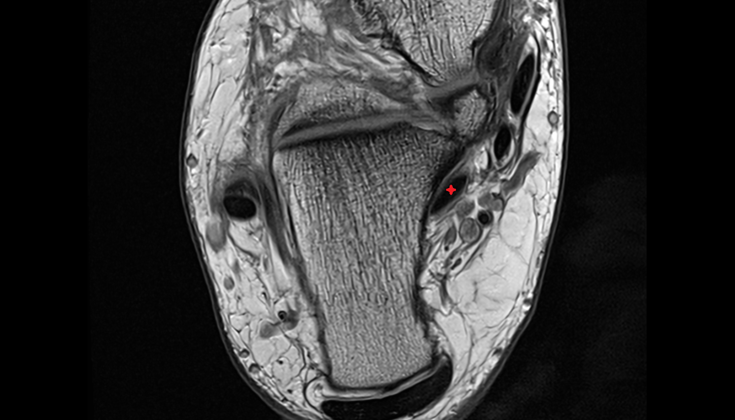 Flexor hallucis longus tendon axial cross sectional anatomy 3T MRI AI enhanced radiology image-img-00000-00000_00003