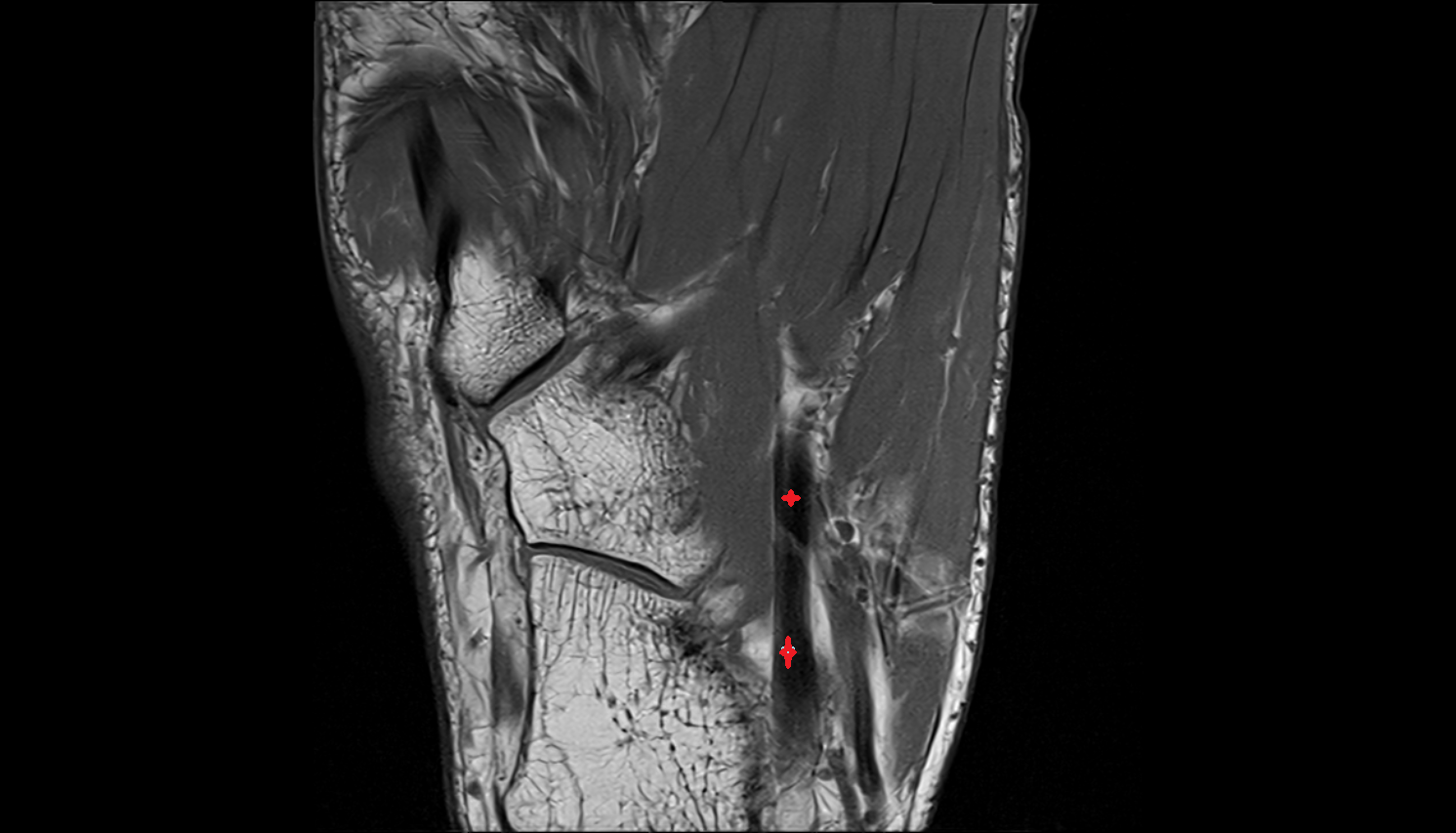 Flexor hallucis longus tendon axial cross sectional anatomy 3T MRI AI enhanced radiology image-img-00000-00004