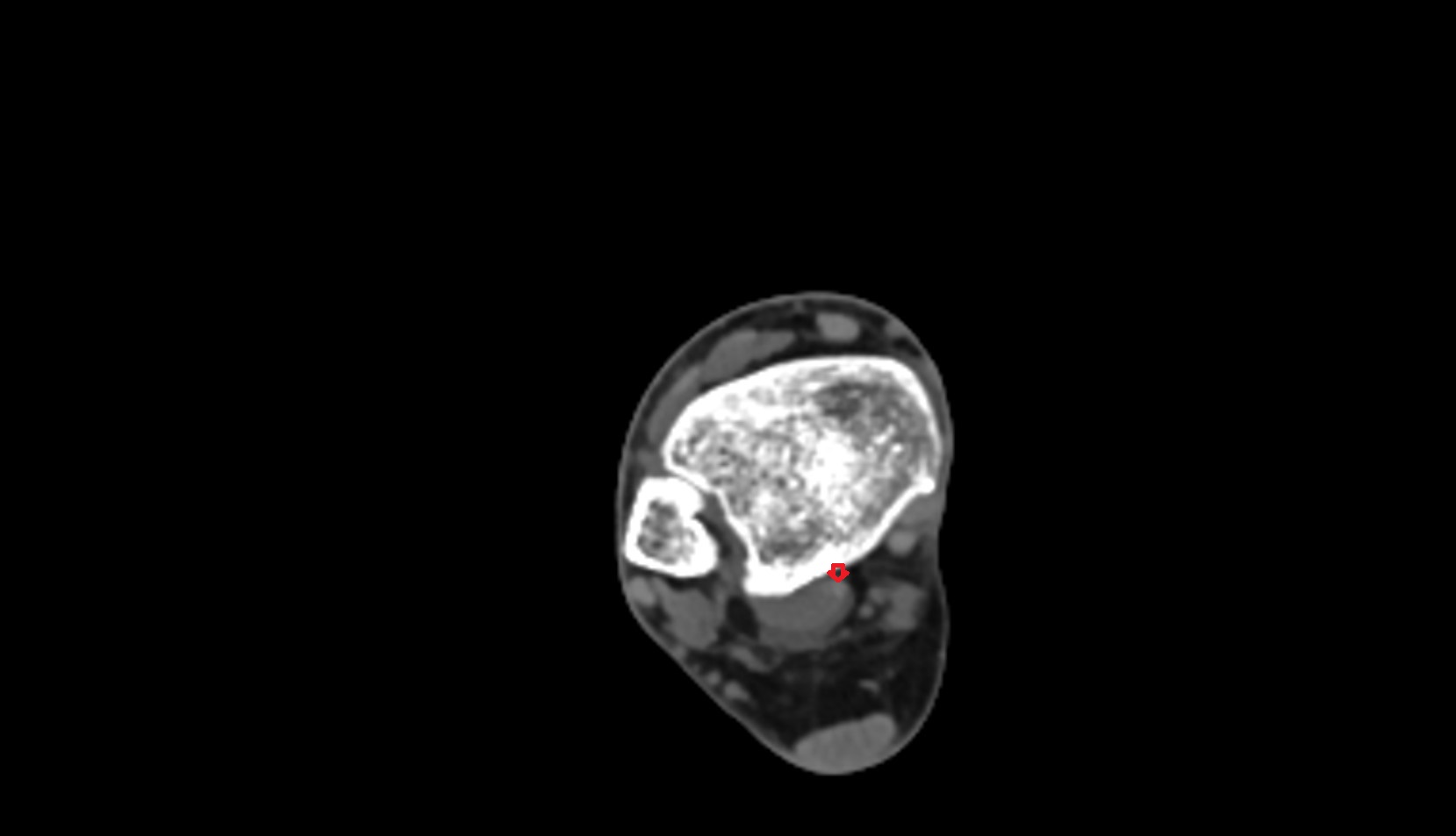 Flexor hallucis longus tendon ct axial image 1