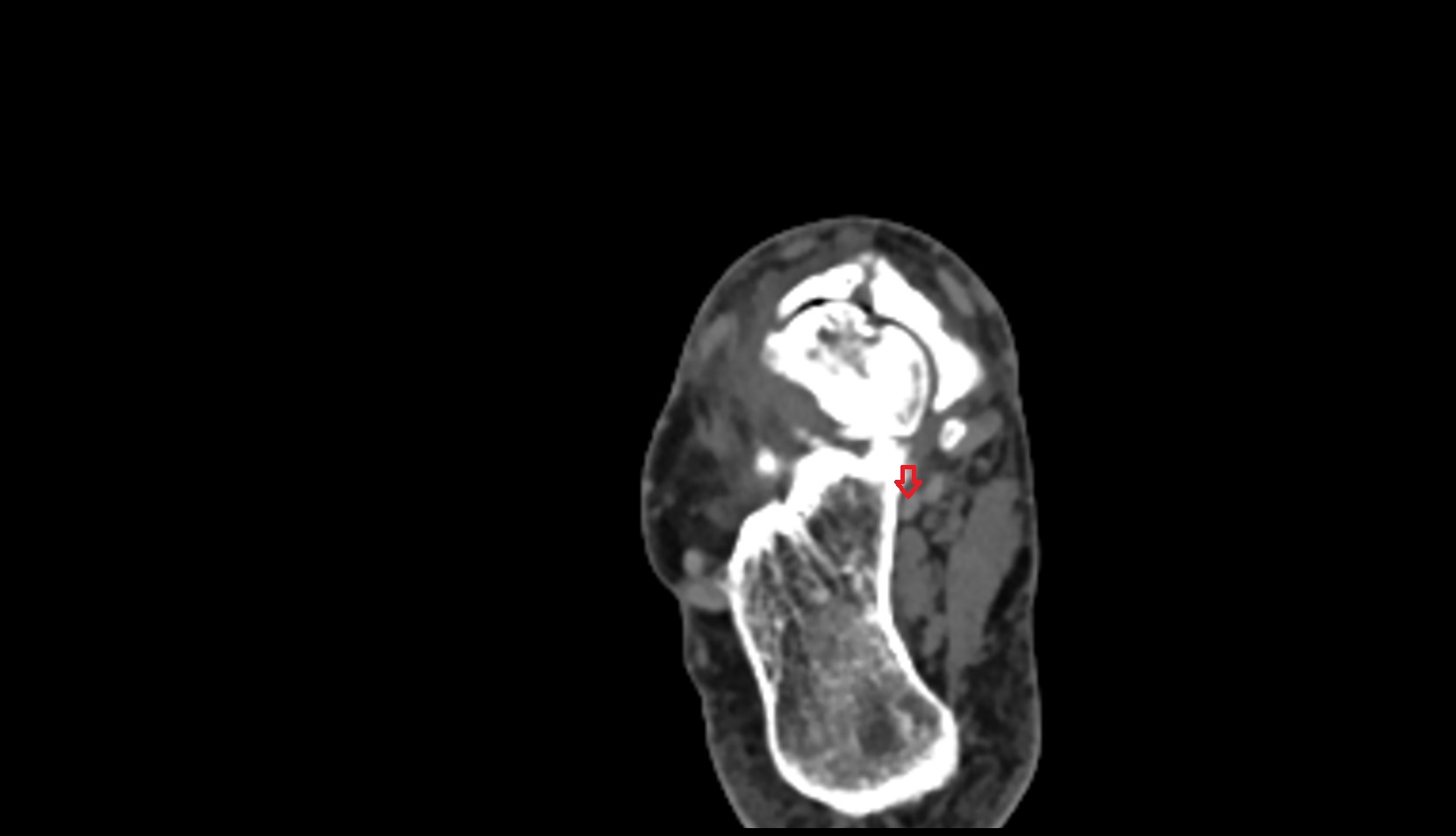 Flexor hallucis longus tendon ct axial image 3