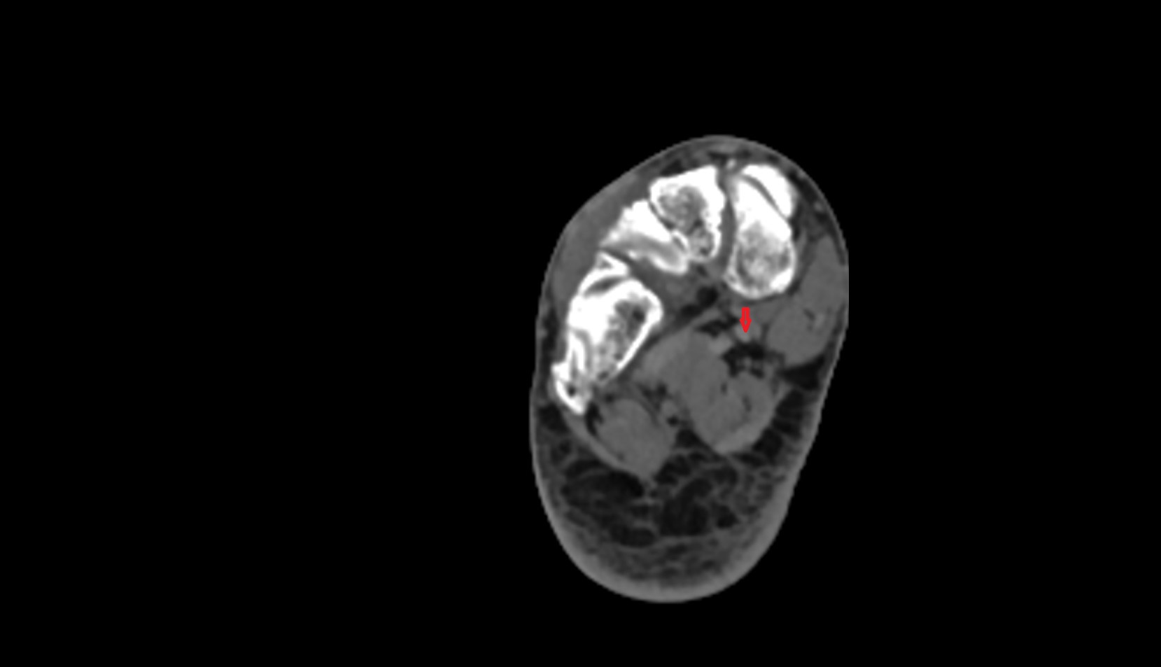 Flexor hallucis longus tendon ct axial image 4