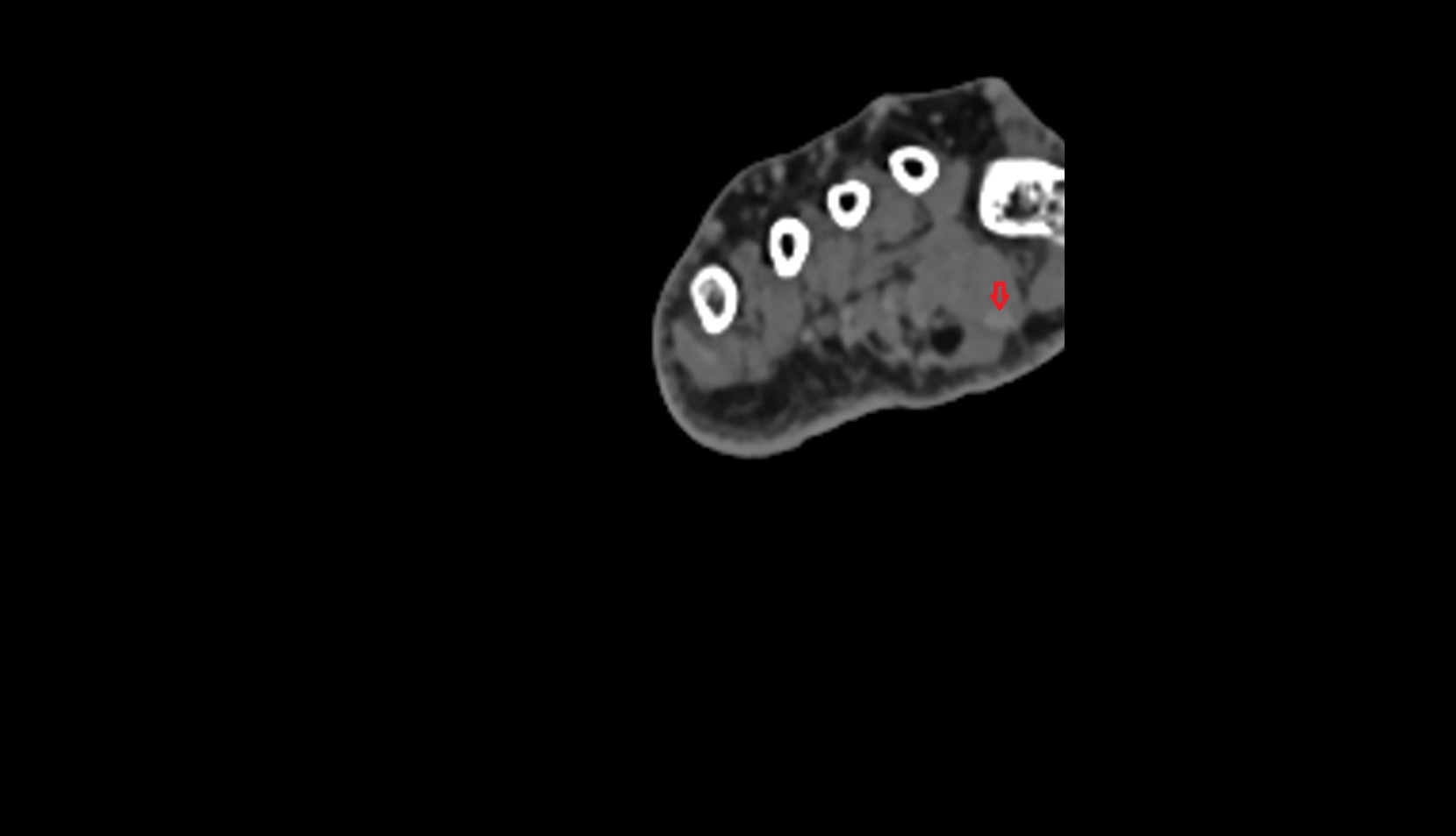 Flexor hallucis longus tendon ct axial image 5