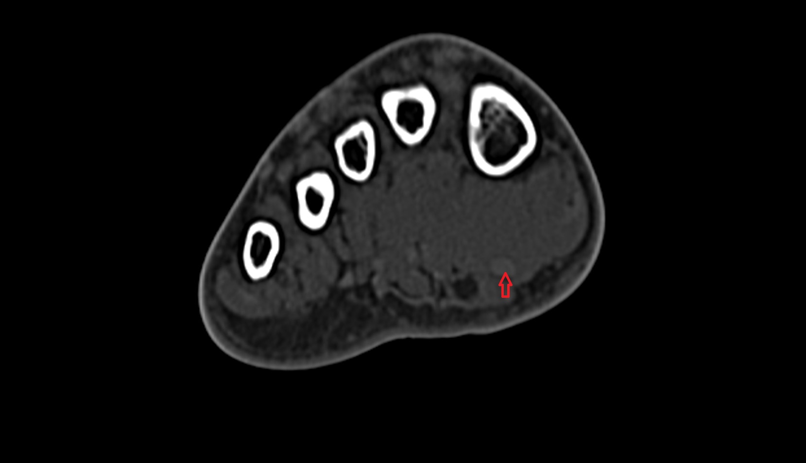 Flexor hallucis longus tendon ct image 3