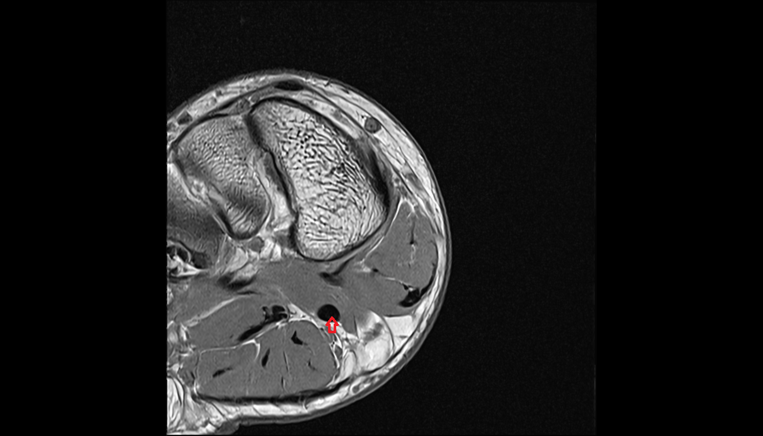 Flexor hallucis longus tendon  of the Foot  axial cross sectional anatomy 3T MRI AI enhanced radiology image-img-00000-00000