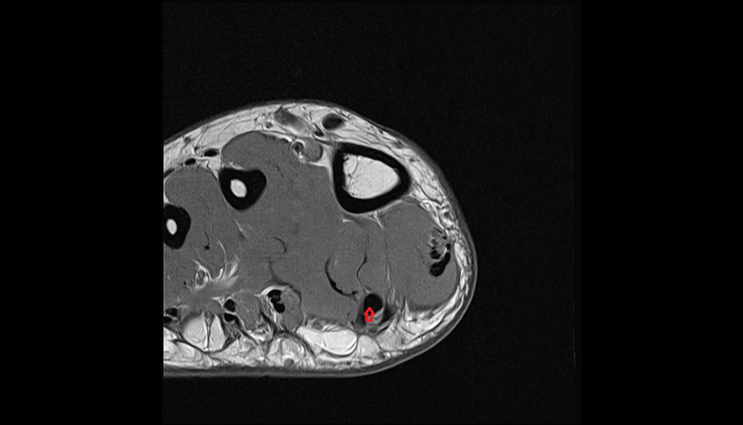 Flexor hallucis longus tendon  of the Foot  axial cross sectional anatomy 3T MRI AI enhanced radiology image-img-00000-00000_00001