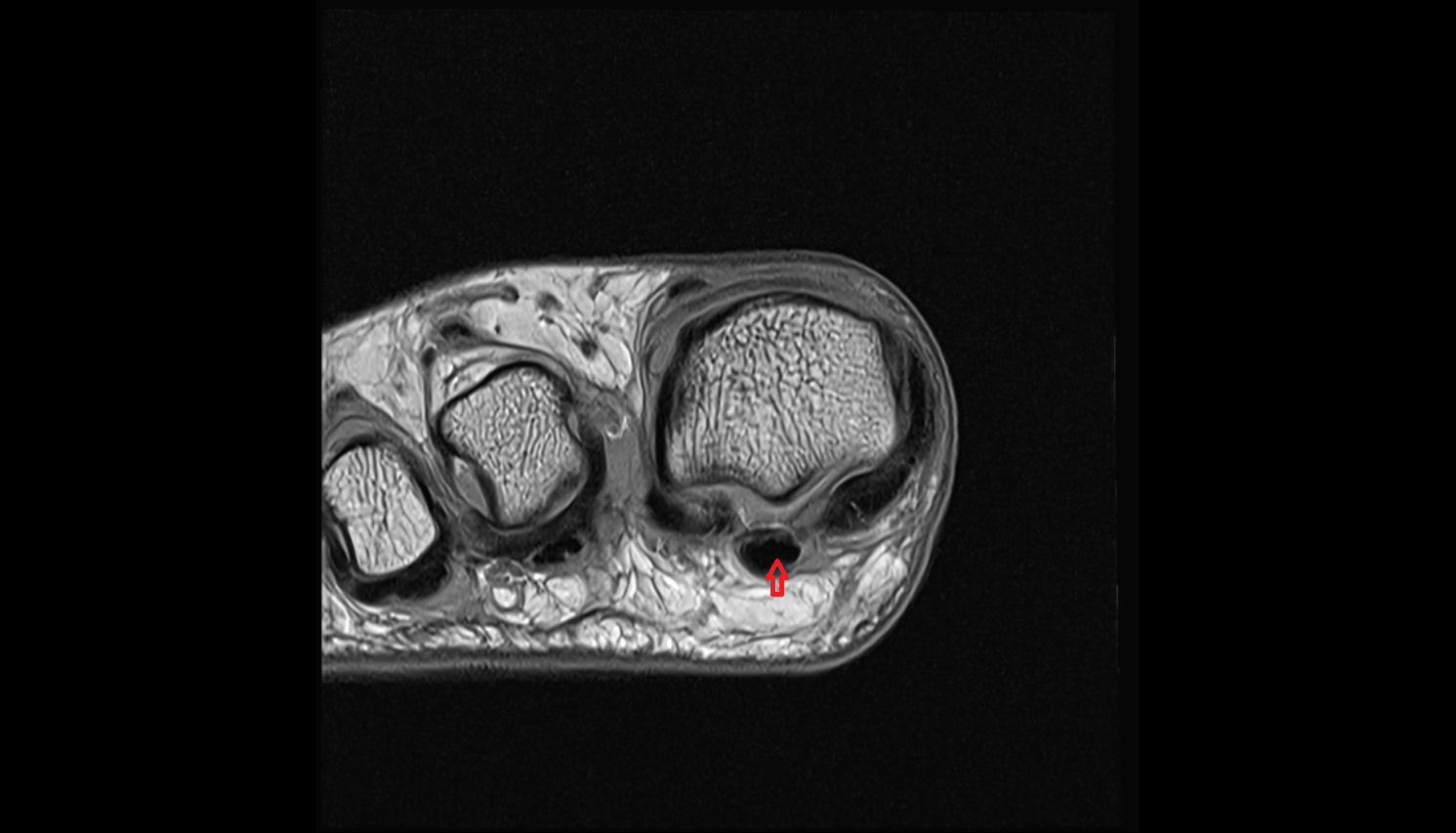Flexor hallucis longus tendon  of the Foot  axial cross sectional anatomy 3T MRI AI enhanced radiology image-img-00000-00000_00002