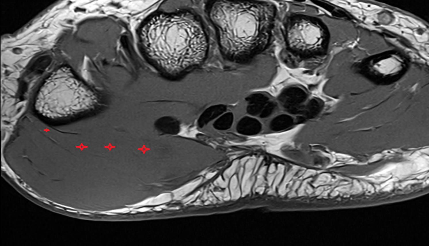 Flexor pollicis brevis muscle (Deep head)  axial cross sectional anatomy 3T MRI AI enhanced radiology image-img-00000-00000