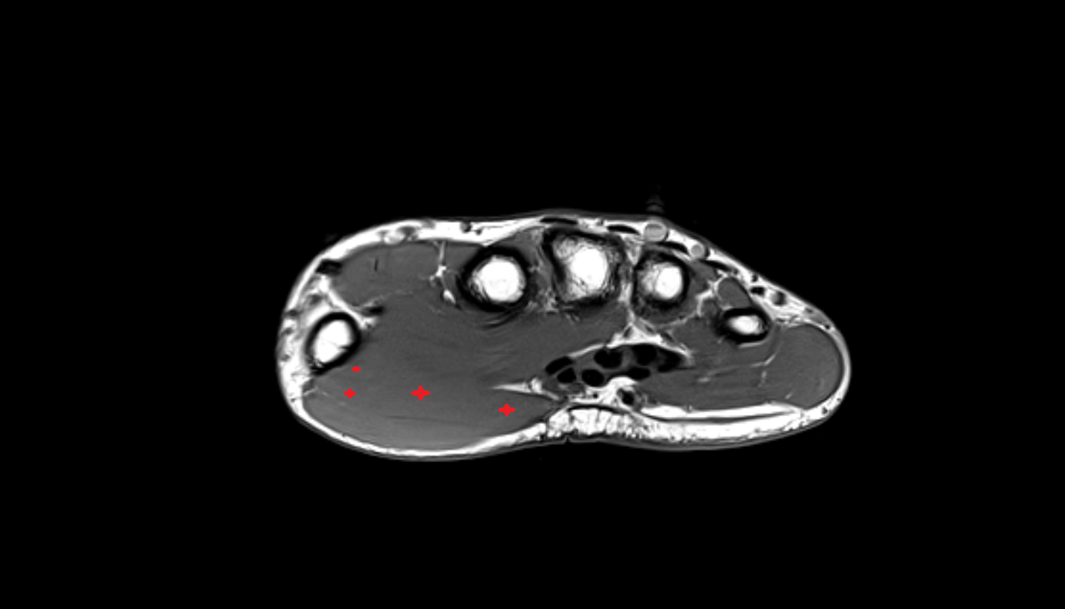 Flexor pollicis brevis muscle axial cross sectional anatomy 3T MRI AI enhanced radiology image-img-00000-00000