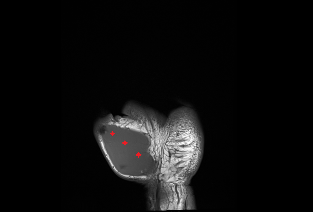 Flexor pollicis brevis muscle coronal cross sectional anatomy 3T MRI AI enhanced radiology image-img-00000-00000