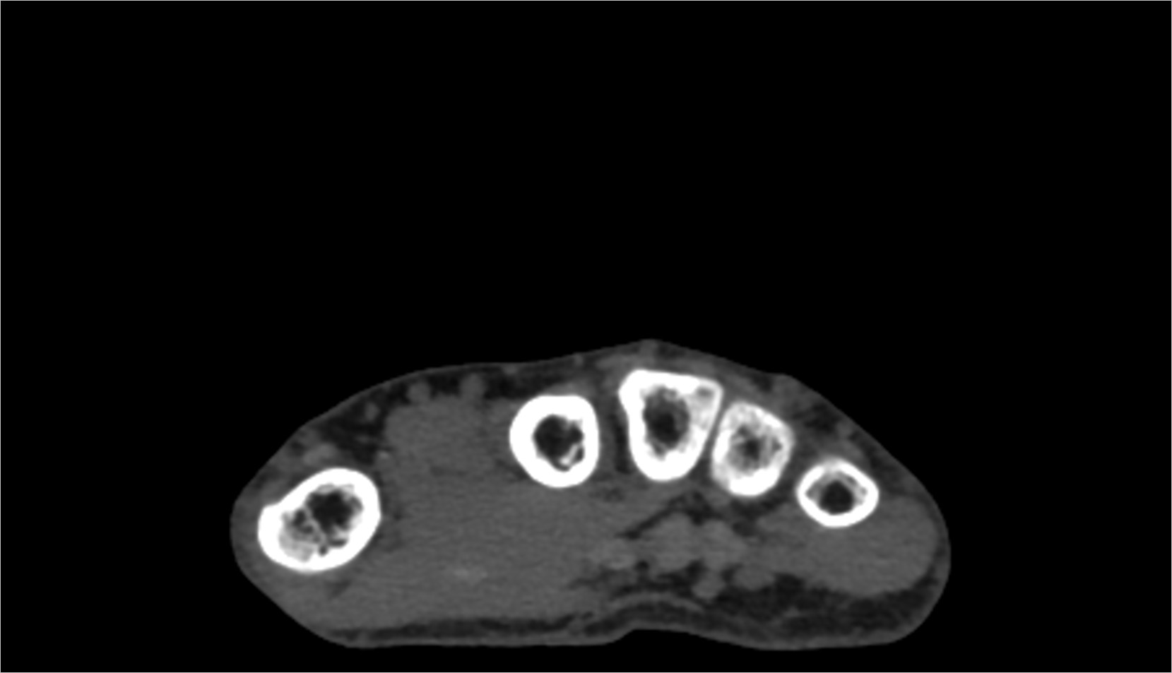 Flexor pollicis brevis musclect axial iamge