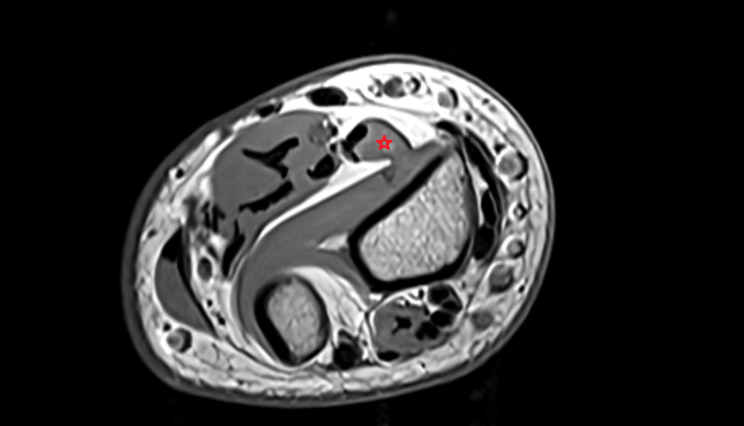 Flexor pollicis longus  muscle axial cross sectional anatomy 3T MRI AI enhanced radiology image-img-00000-00000