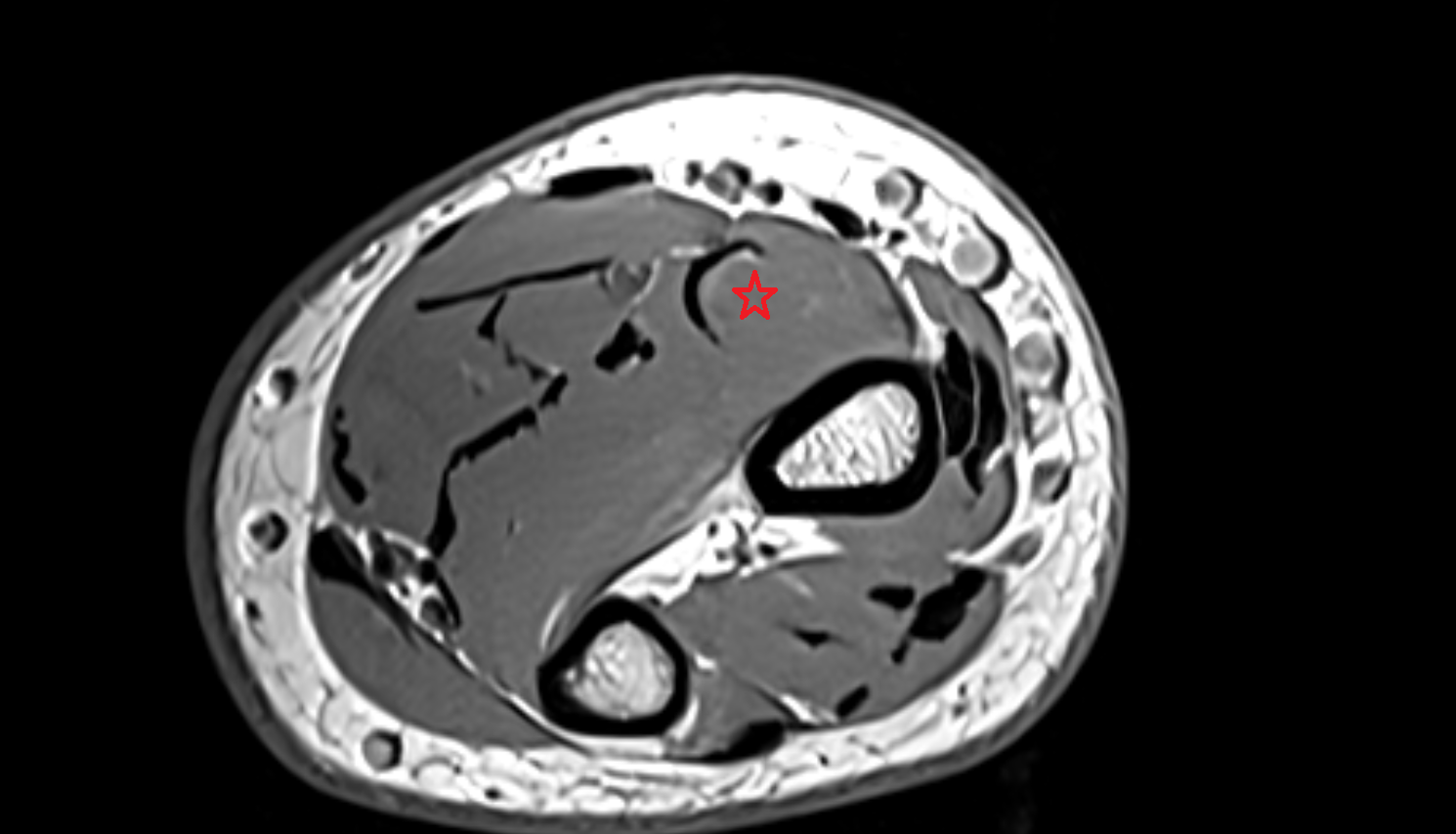Flexor pollicis longus  muscle axial cross sectional anatomy 3T MRI AI enhanced radiology image-img-00000-00000_00001
