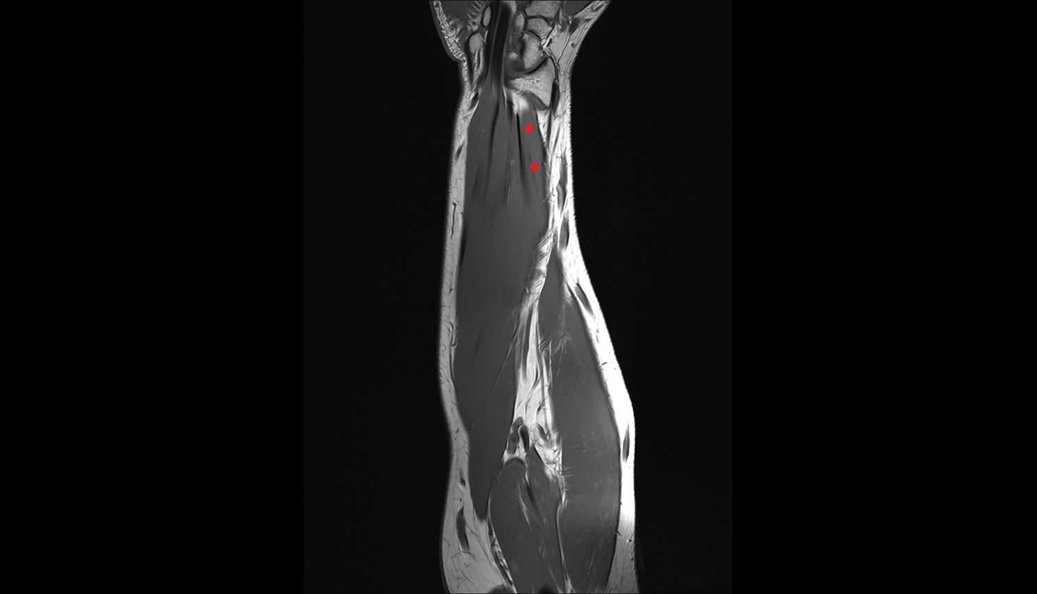 Flexor pollicis longus  muscle coronal cross sectional anatomy 3T MRI AI enhanced radiology image-img-00000-00000