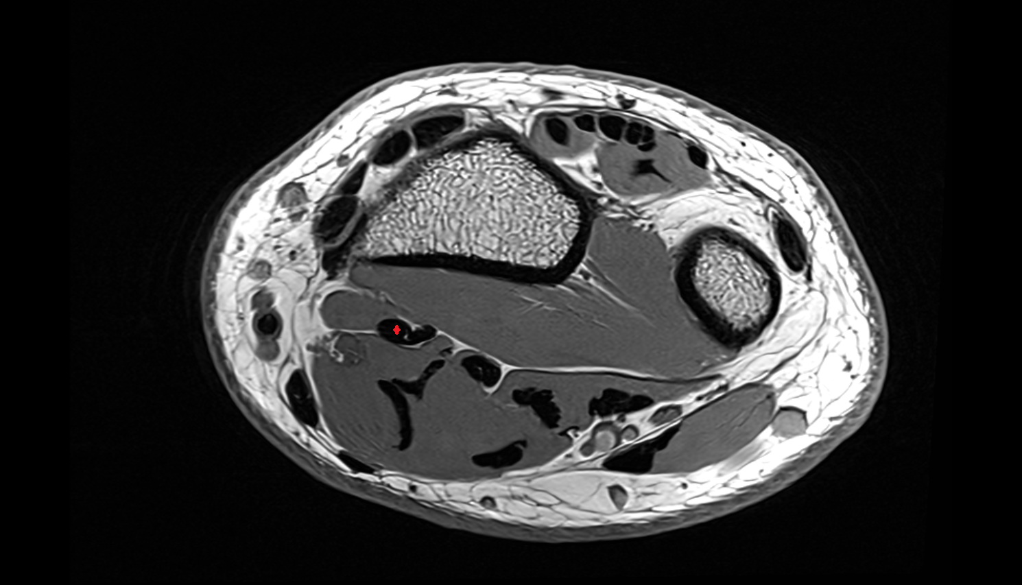 Flexor pollicis longus tendon  axial cross sectional anatomy 3T MRI AI enhanced radiology image-img-00000-00000