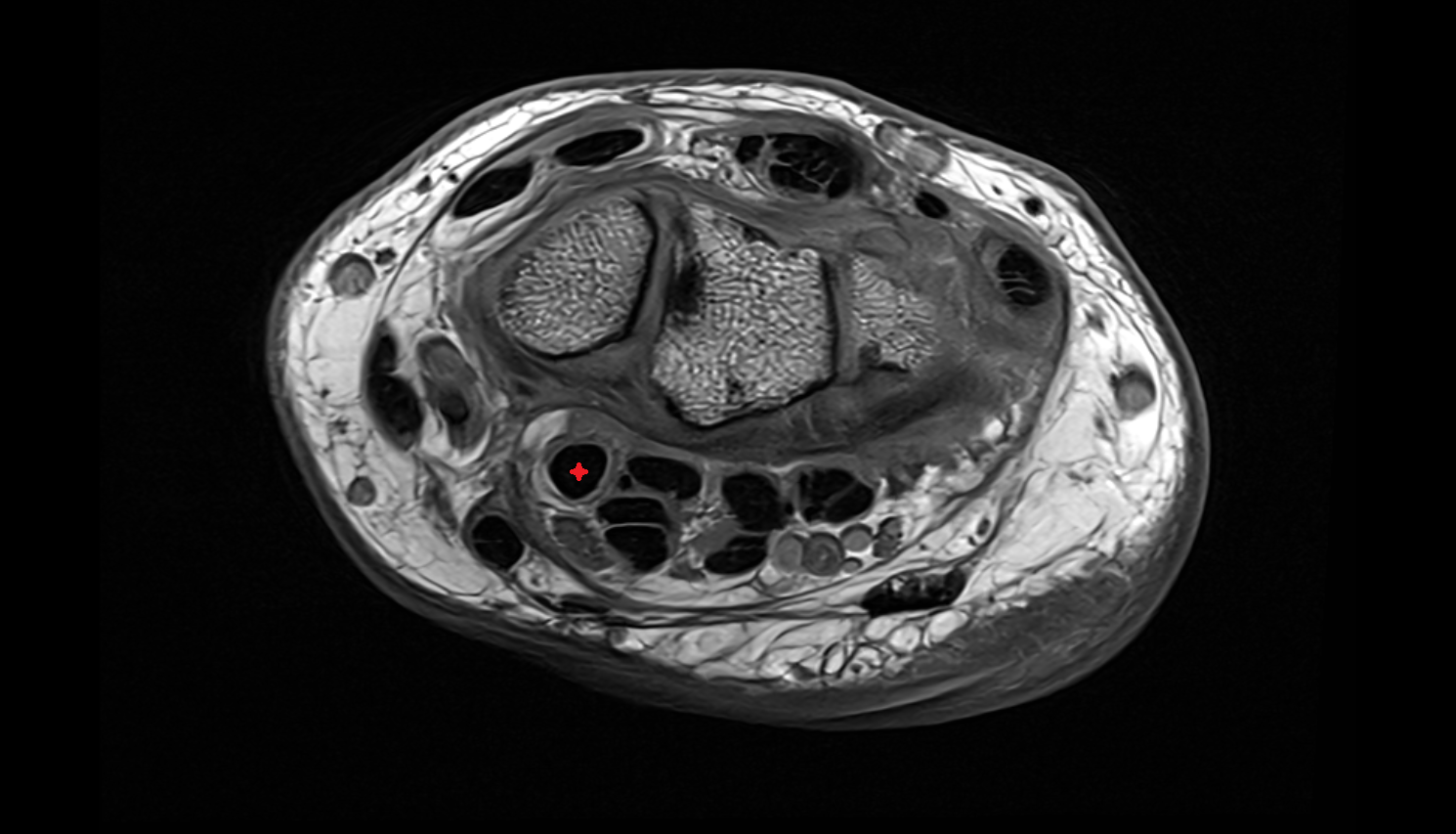 Flexor pollicis longus tendon  axial cross sectional anatomy 3T MRI AI enhanced radiology image-img-00000-00000_00001