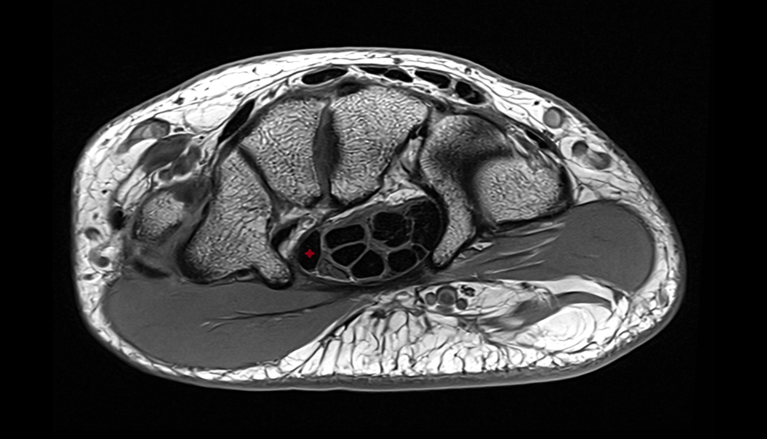 Flexor pollicis longus tendon  axial cross sectional anatomy 3T MRI AI enhanced radiology image-img-00000-00000_00002