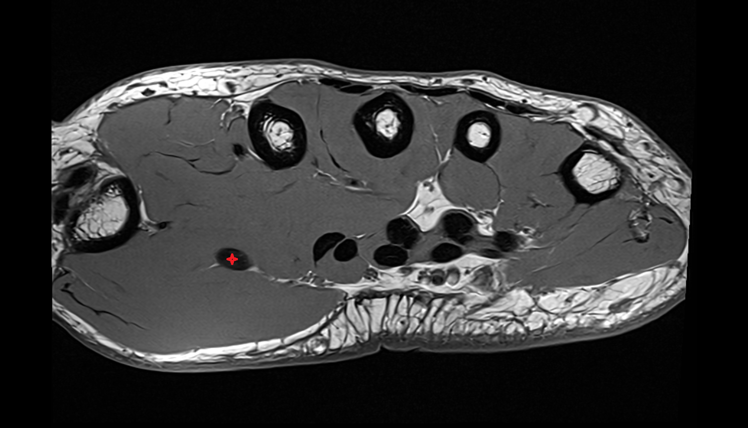 Flexor pollicis longus tendon  axial cross sectional anatomy 3T MRI AI enhanced radiology image-img-00000-00000_00003