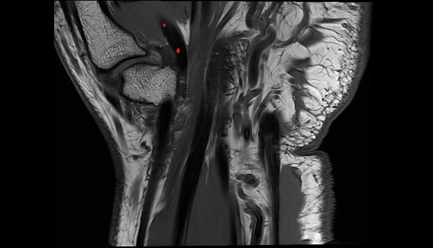 Flexor pollicis longus tendon coronal cross sectional anatomy 3T MRI AI enhanced radiology image-img-00000-00000_00001