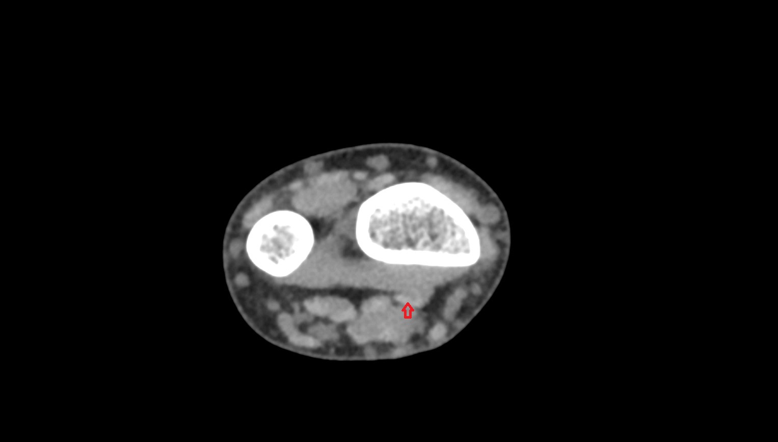 Flexor pollicis longus tendon ct axial