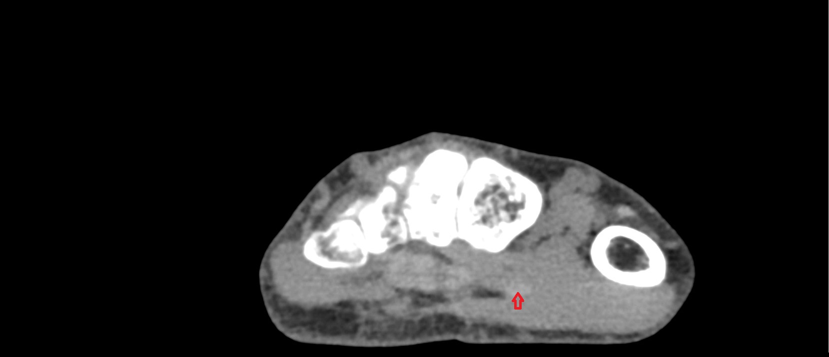 Flexor pollicis longus tendon ct axial image