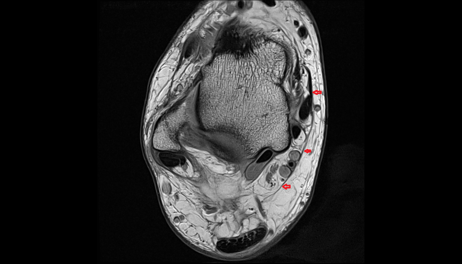 Flexor retinaculum axial  cross sectional anatomy 3T MRI AI enhanced radiology image-img-00000-00000