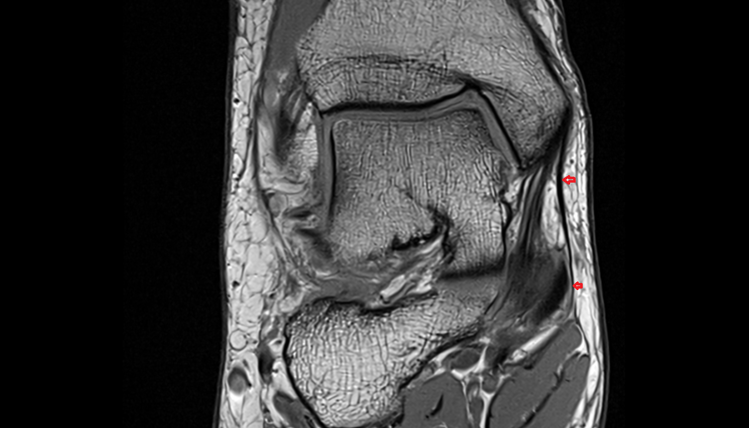 Flexor retinaculum  coronal  cross sectional anatomy 3T MRI AI enhanced radiology image-img-00000-00000