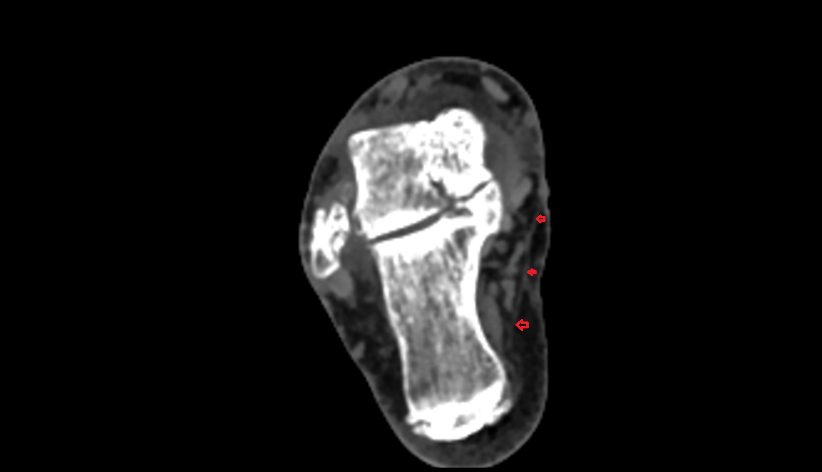 Flexor retinaculum ct axial image