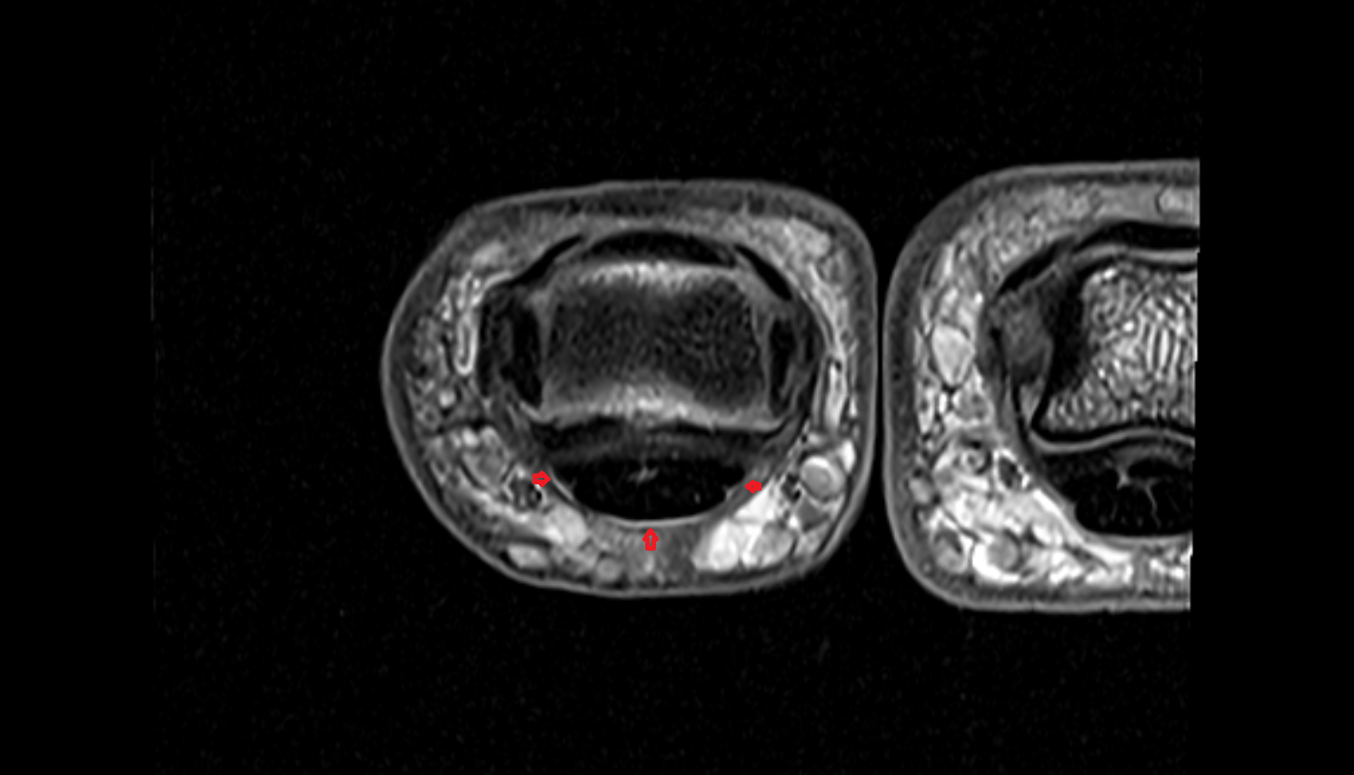 Flexor tendon synovial sheath hand  MRI axial  image-img-00000-00000