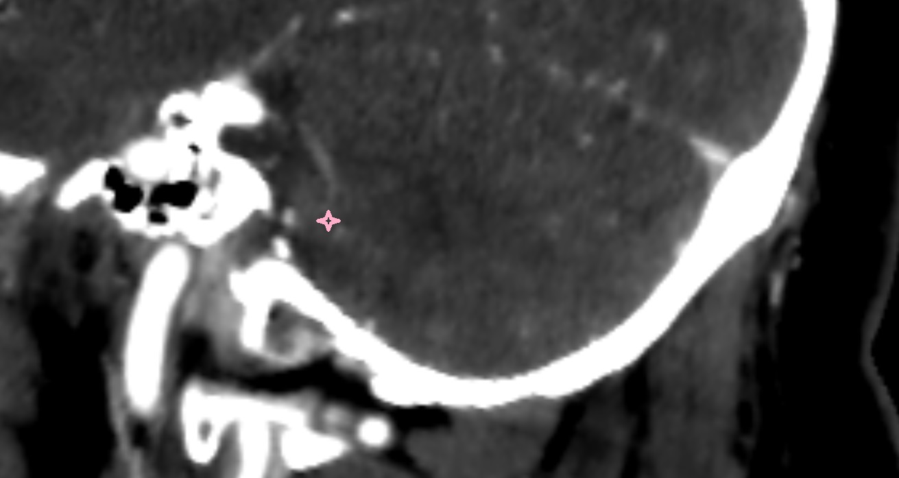 Flocculonodular lobe CT sag  anatomy image -img-00001-00001
