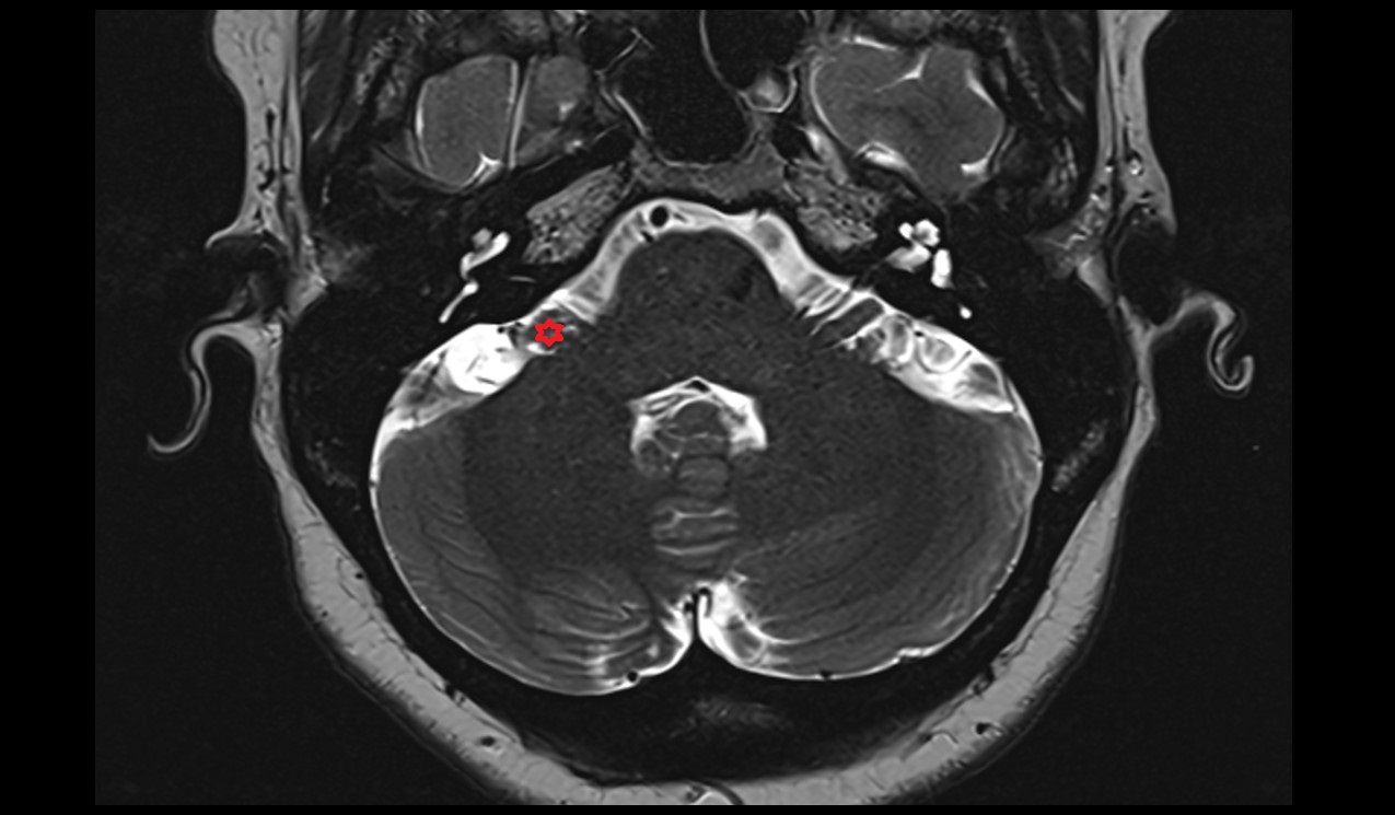 Flocculonodular lobe MRI 3T axial image