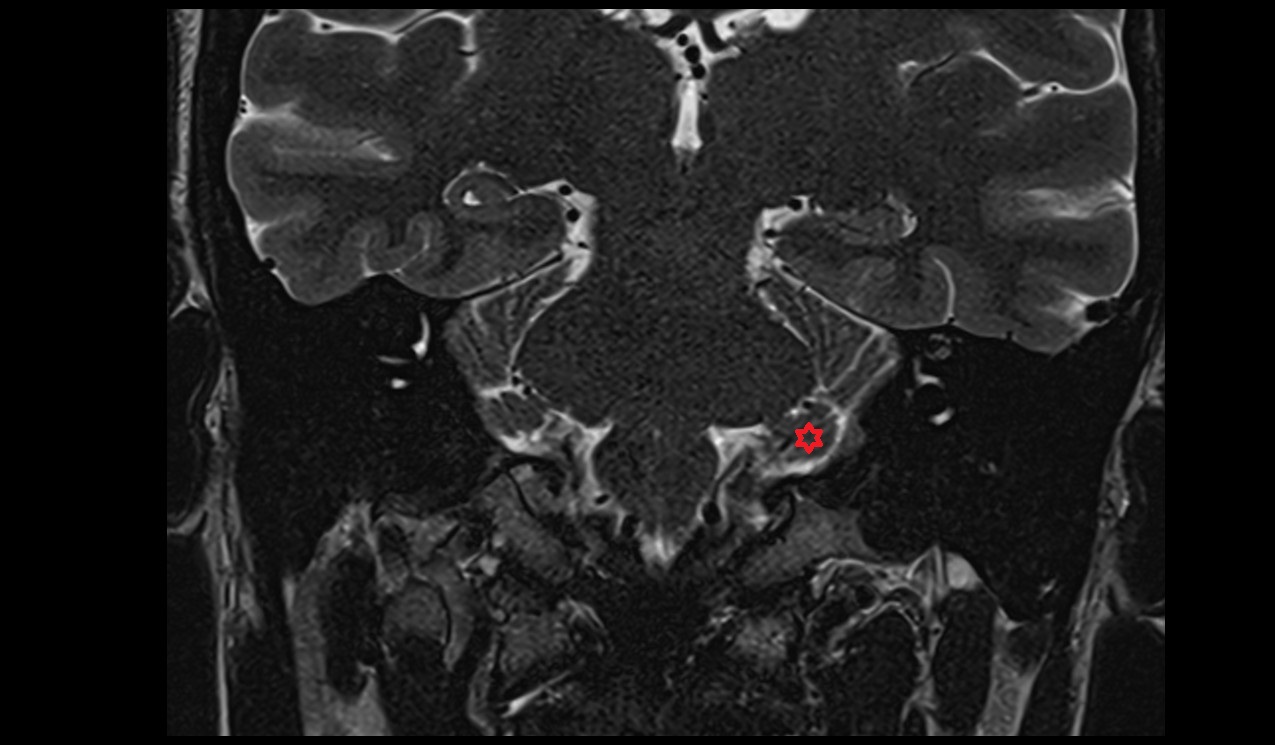 Flocculonodular lobe MRI 3T coronal image