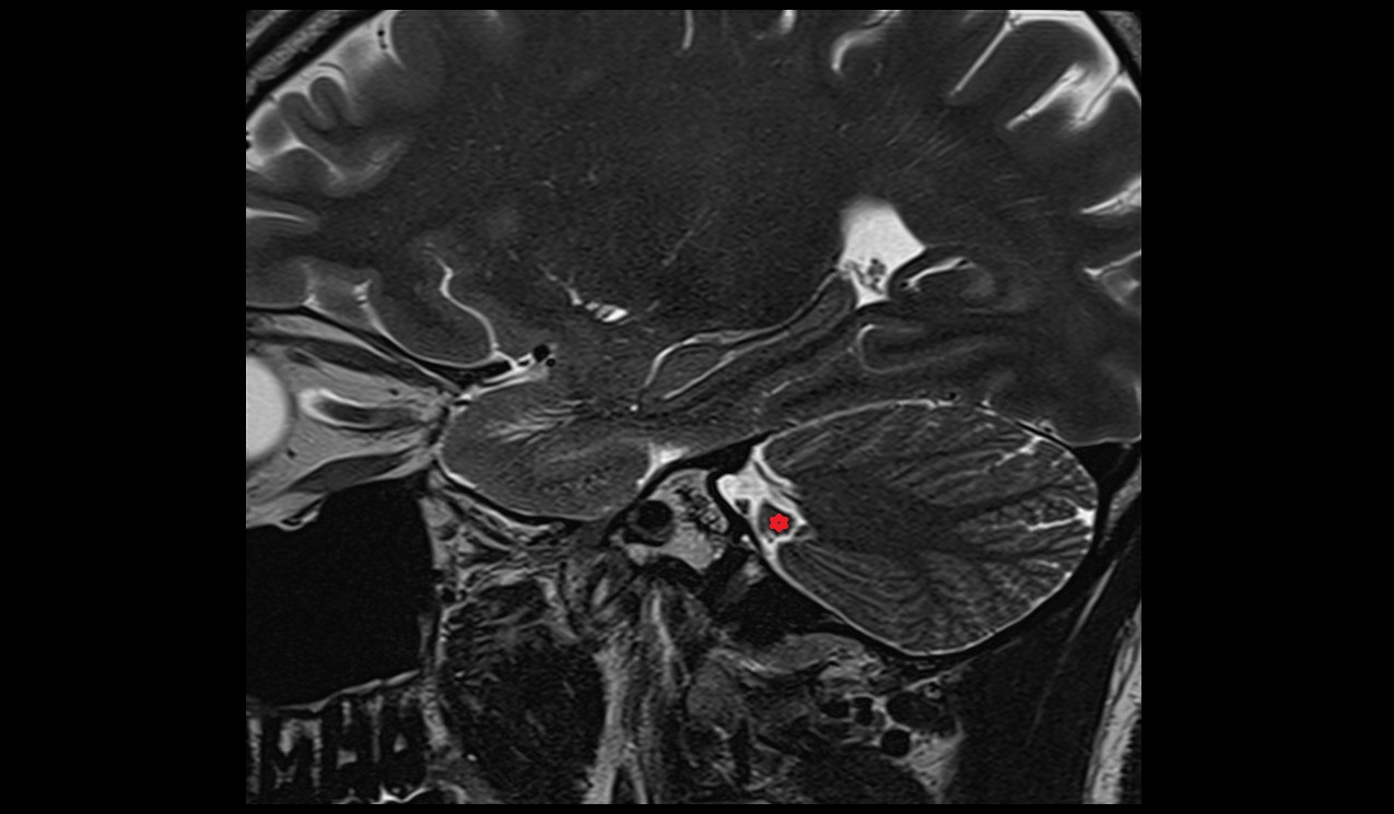 Flocculonodular lobe MRI 3T sagittal image
