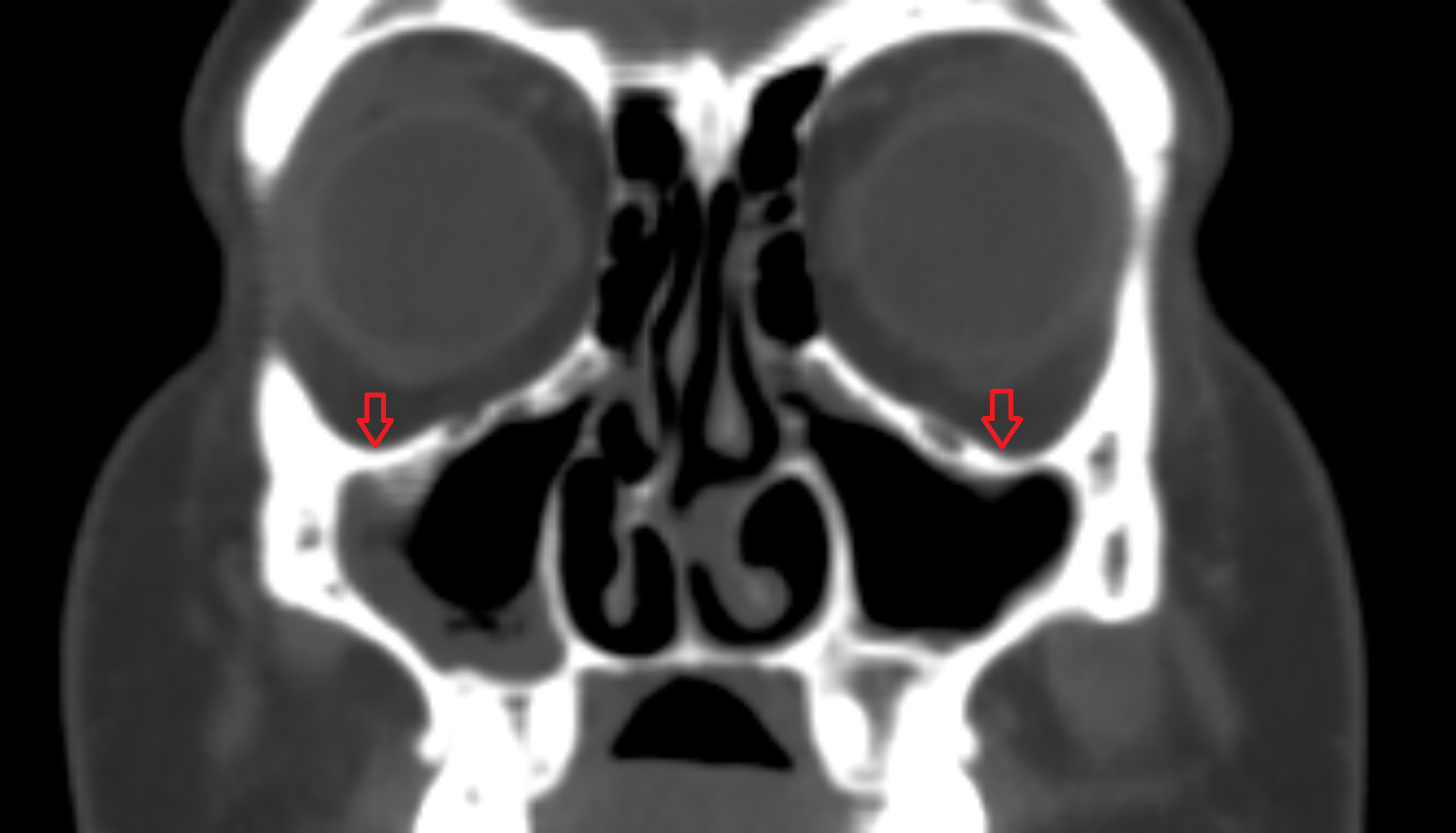 Floor of orbit CT  anatomy labelled image-img-00000-00000