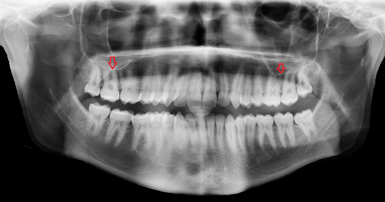 Floor of the maxillary sinus