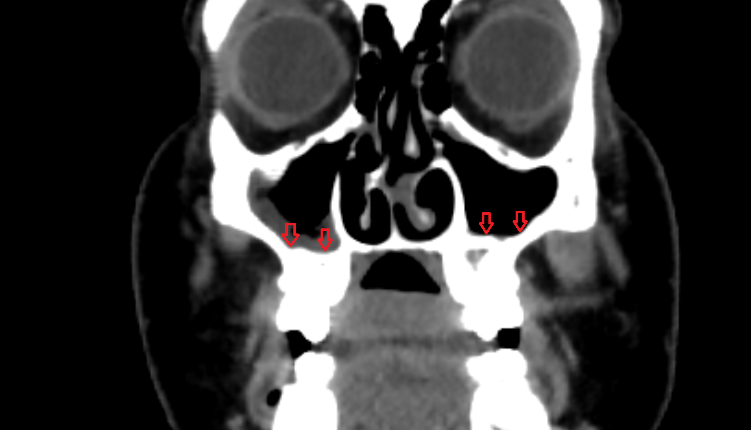 Floor of the maxillary sinus CT  anatomy labelled image-img-00000-00000