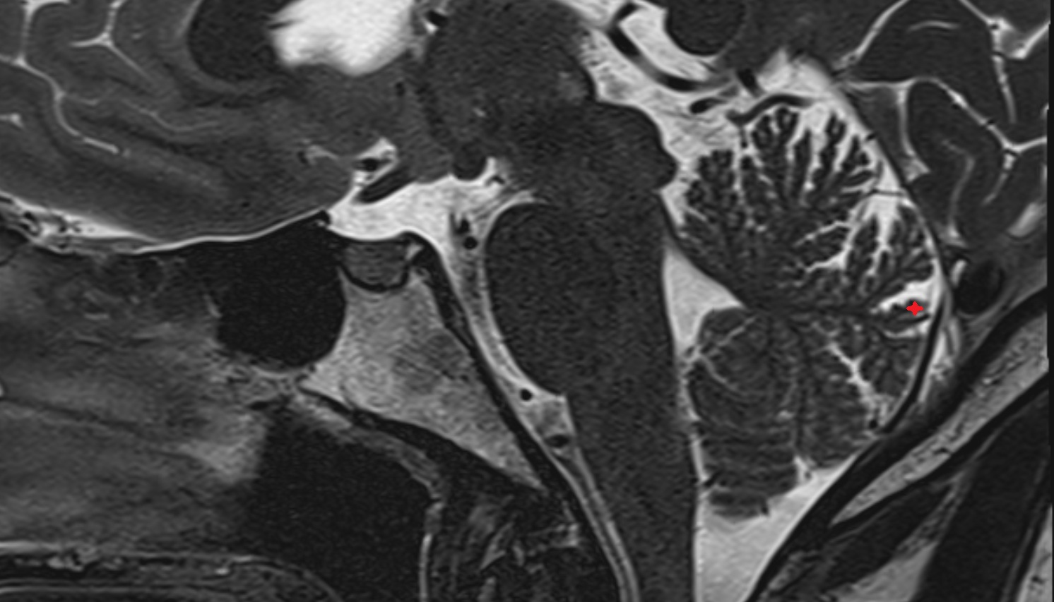 Folium (VII) of Cerebellum mri sag  image -img-00000-00000