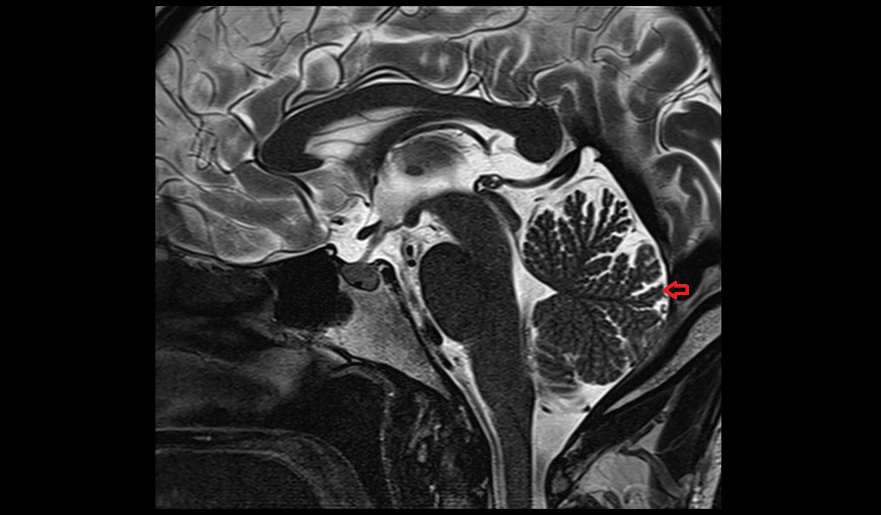 Folium of vermis [VII A] mri 3t sagittal image