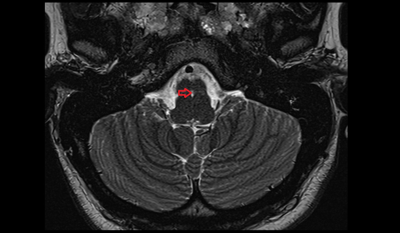 Foramen caecum of medulla oblongata  mri 3t axial image
