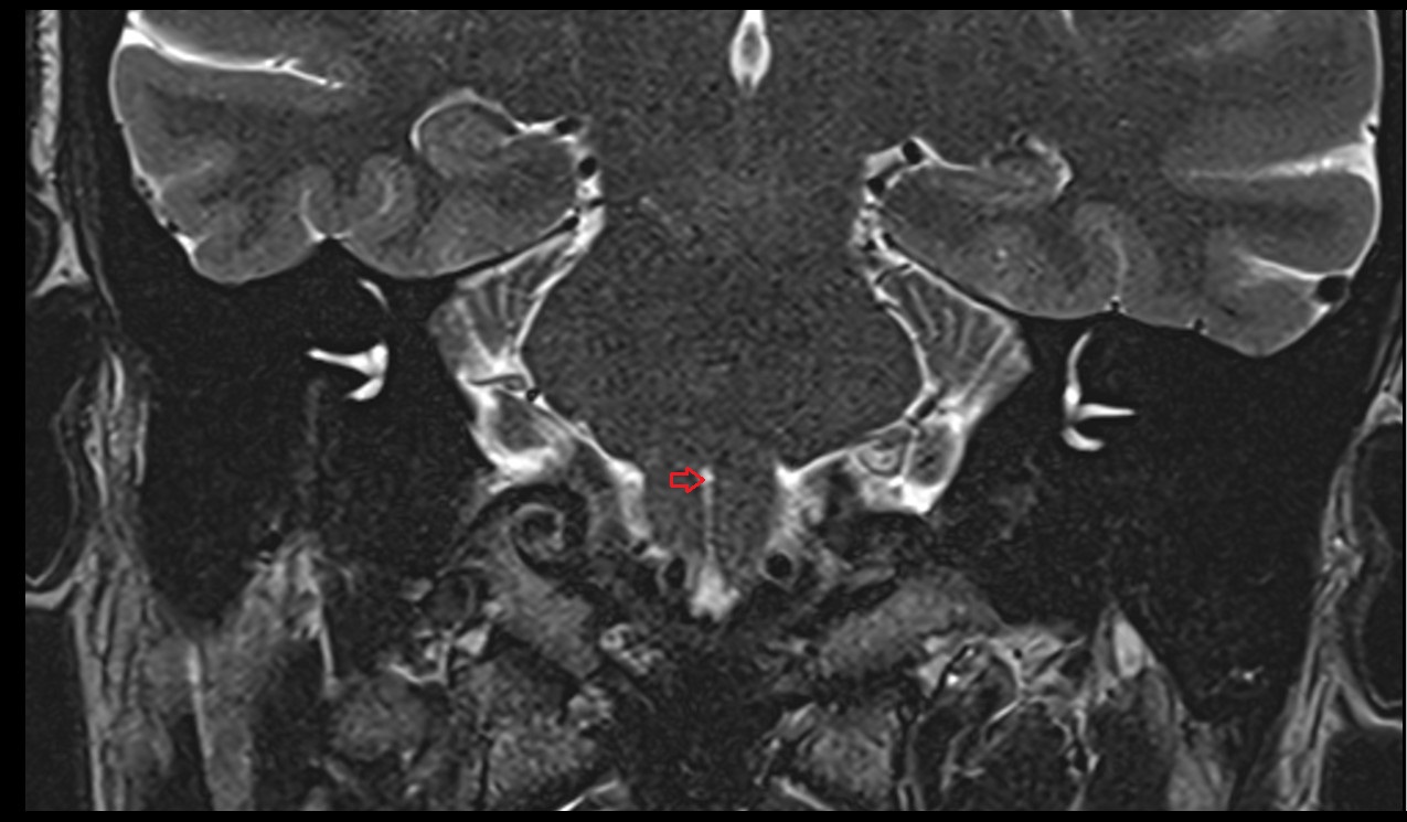 Foramen caecum of medulla oblongata  mri 3t coronl image