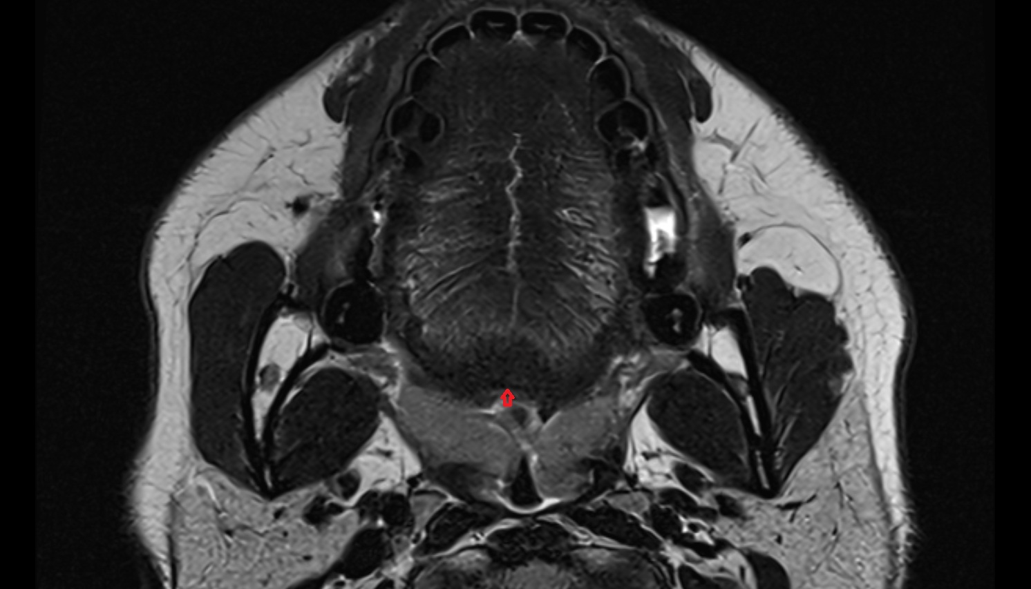 Foramen cecum of tongue  mri axial image -img-00000-00000