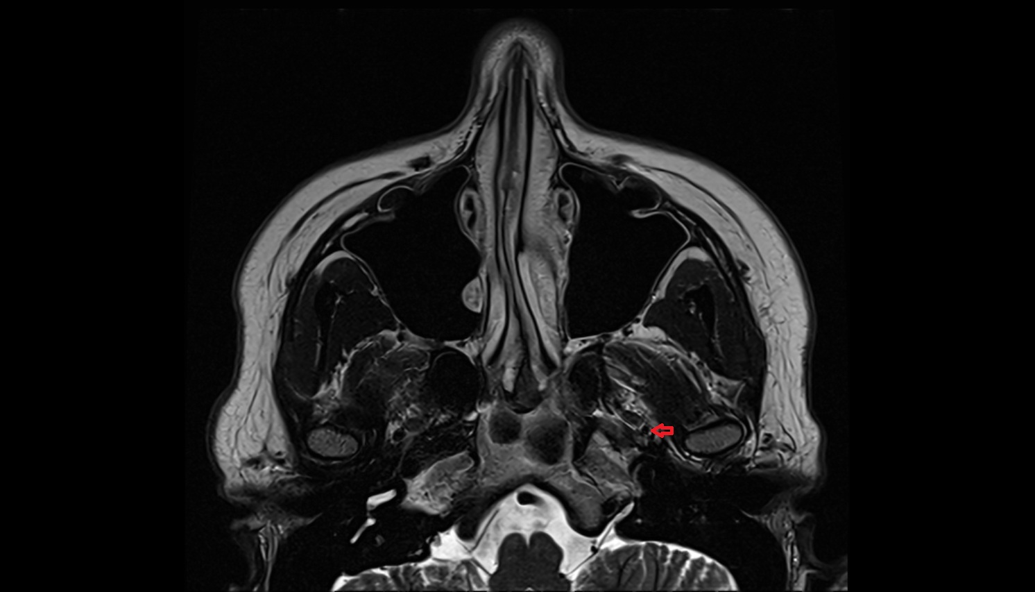 Foramen spinosum mri axial image -img-00000-00000