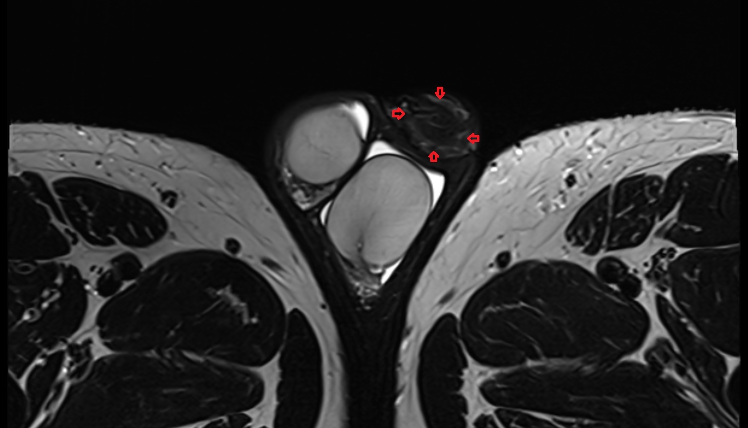 Foreskin of penis   mri  axial  anatomy  image-img-00000-00000