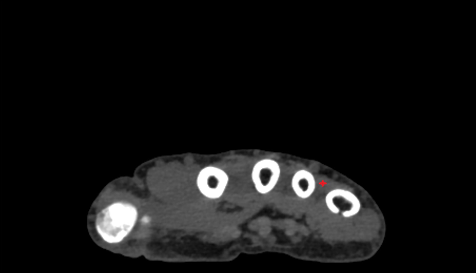 Fourth dorsal interosseous muscle ct axial image