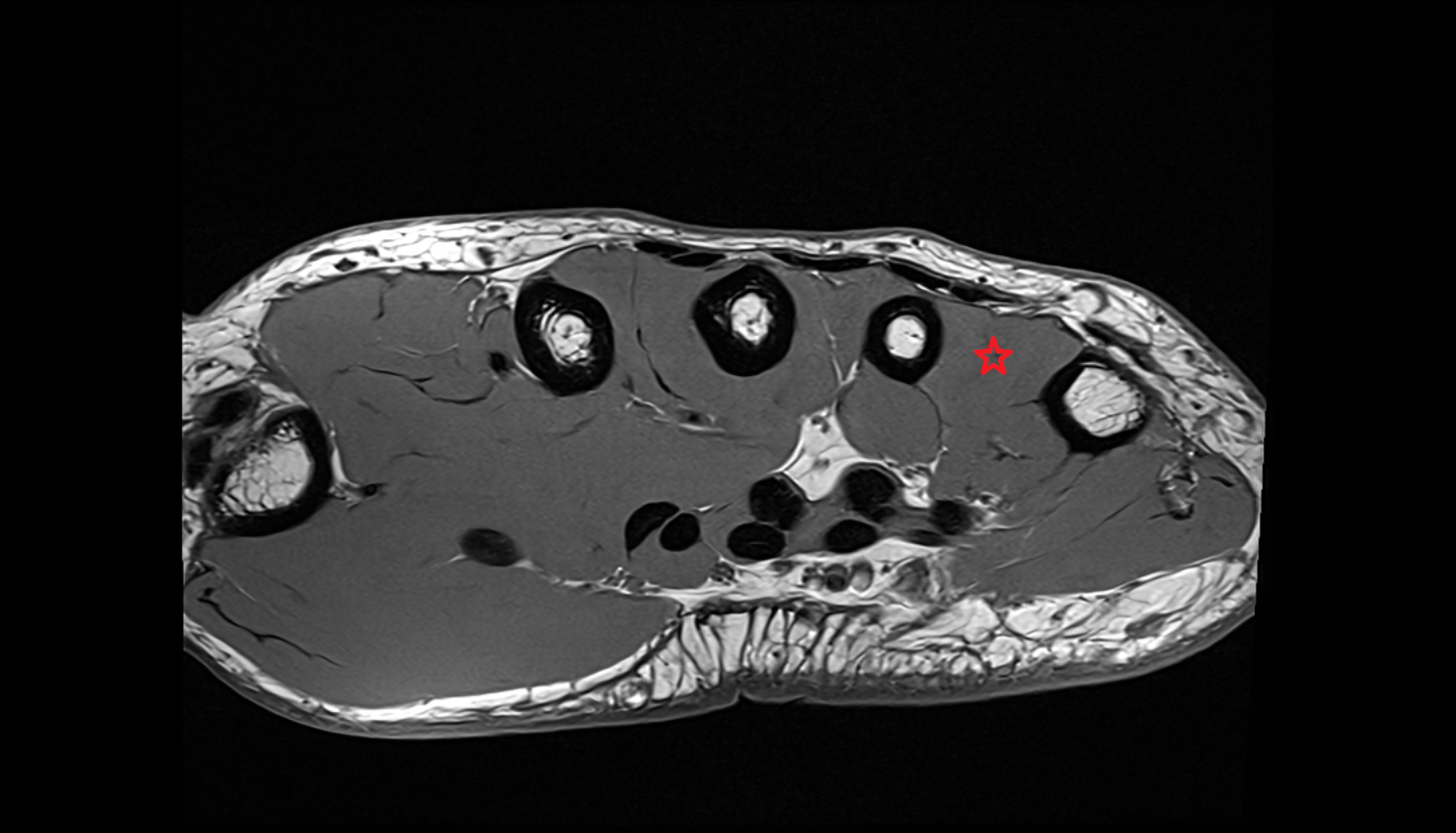 Fourth dorsal interosseous muscle of hand of hand axial cross sectional anatomy 3T MRI AI enhanced radiology image-img-00000-00000_00001