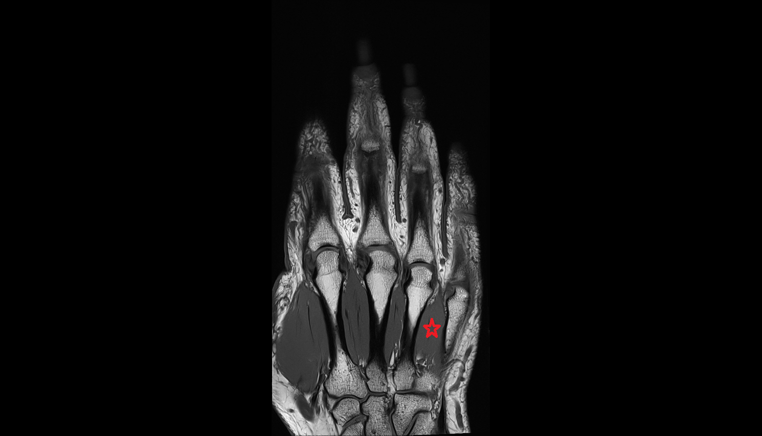 Fourth dorsal interosseous muscle of hand of hand coronal cross sectional anatomy 3T MRI AI enhanced radiology image-img-00000-00000