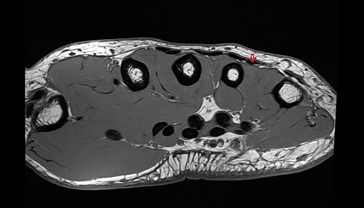 Fourth extensor digitorum tendon (Extensor digitorum tendon to little finger)  axial cross sectional anatomy 3T MRI AI enhanced radiology image-img-00000-00000