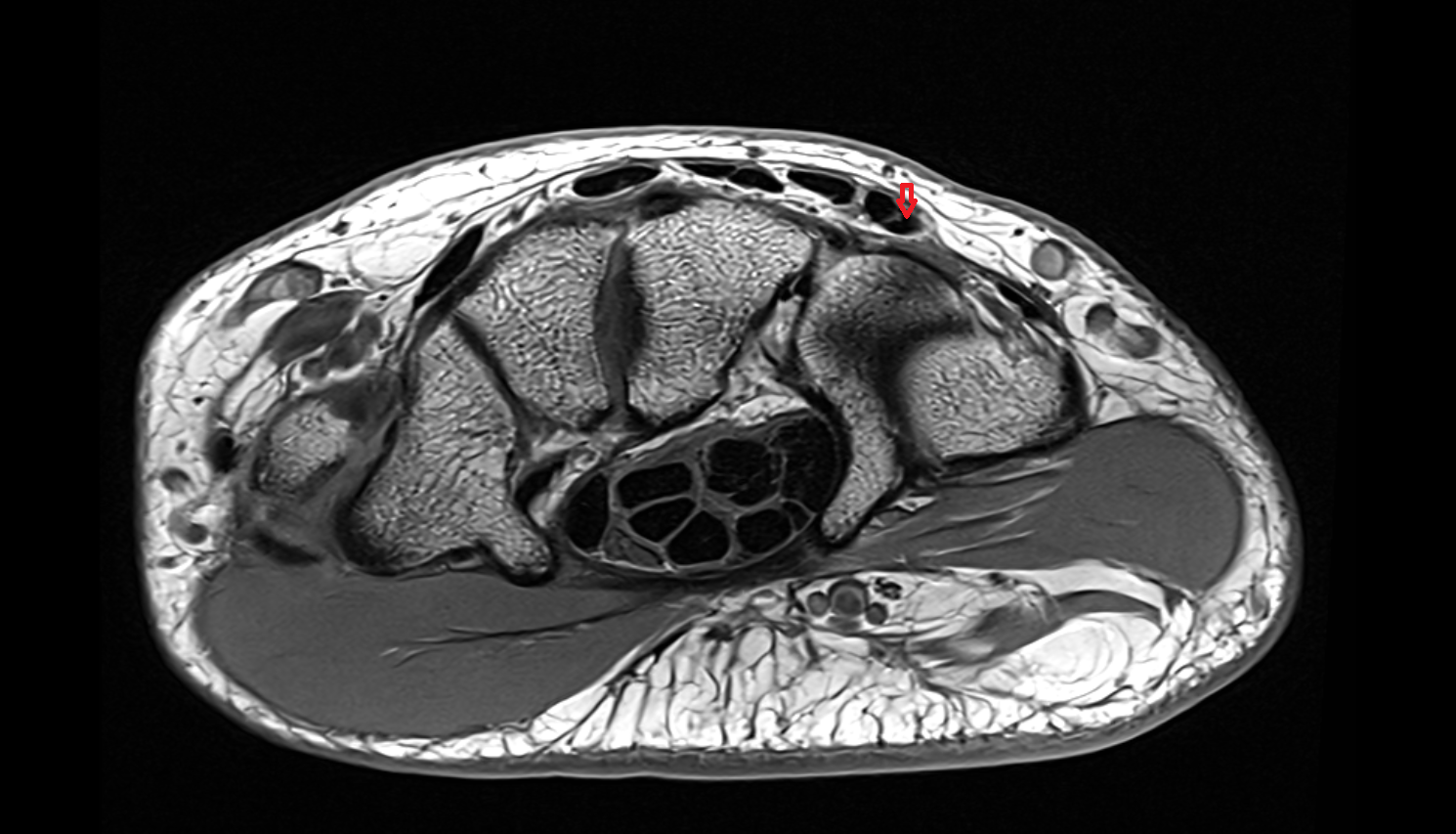 Fourth extensor digitorum tendon (Extensor digitorum tendon to little finger)  axial cross sectional anatomy 3T MRI AI enhanced radiology image-img-00000-00000_00001