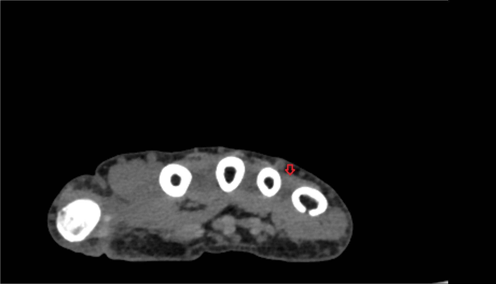 Fourth extensor digitorum tendon (Extensor digitorum tendon to little finger) ct axial