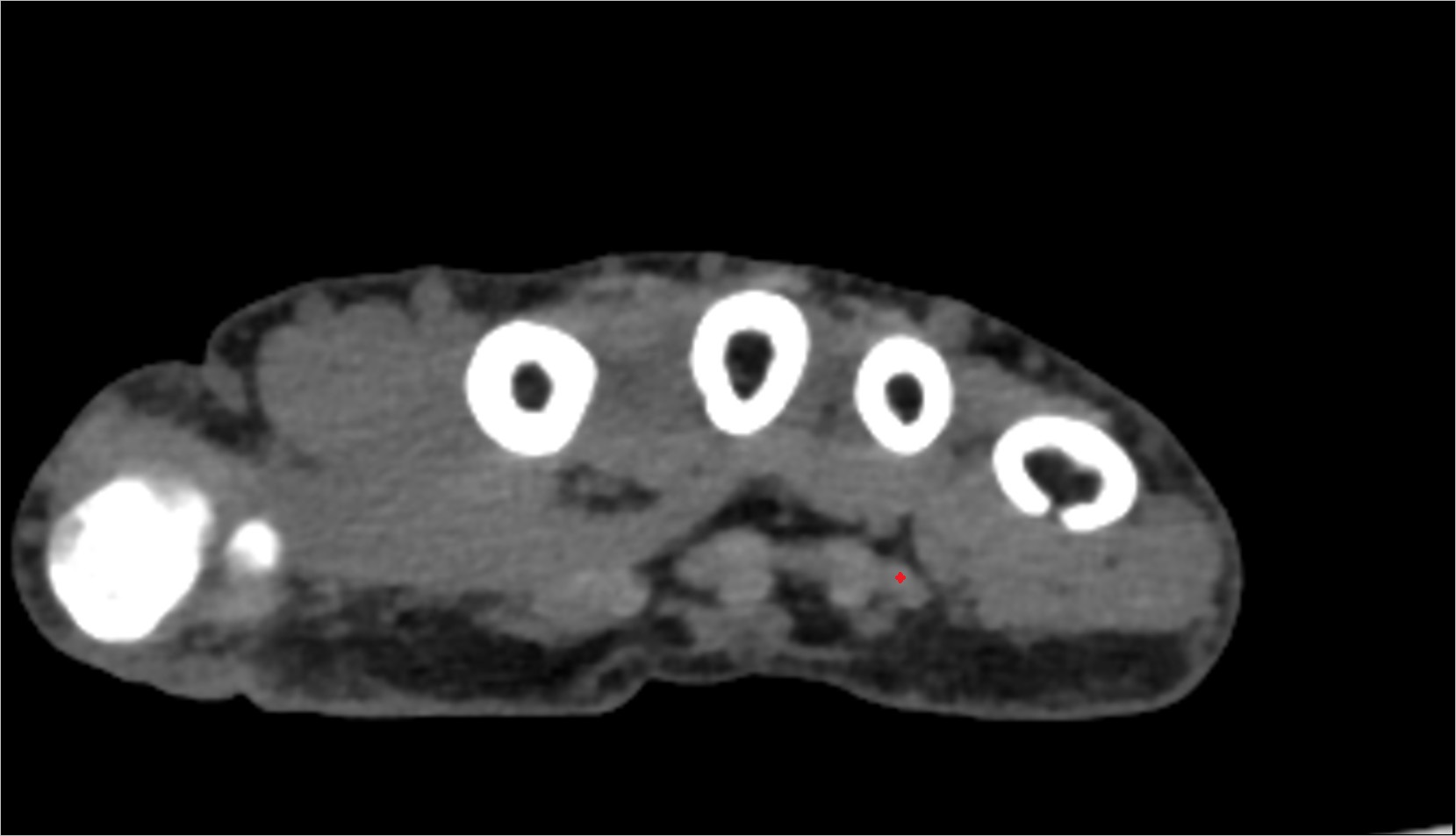 Fourth flexor digitorum profundus tendon (little) ct image